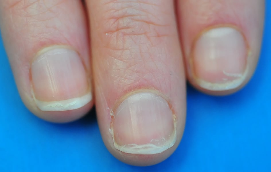 uñas dobles