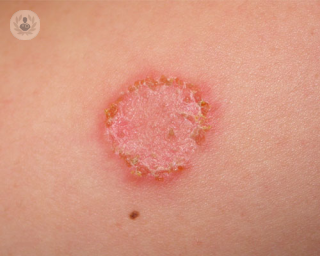 ¿Cuidado con los hongos en la piel: síntomas y tratamientos?