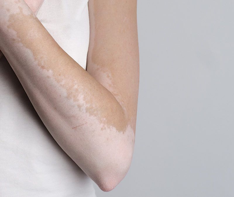 ¿Qué son las manchas blancas en la piel? Origen y tratamiento
