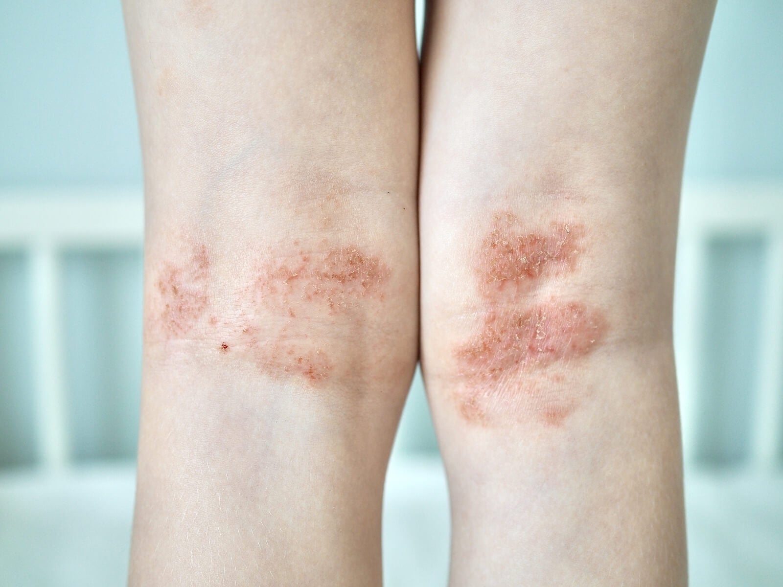 Causas y tratamiento de las manchas rojas en la piel
