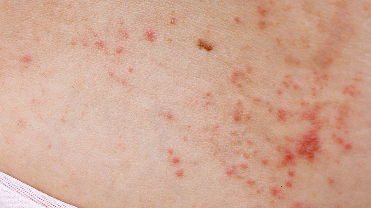 ¿Qué podrían significar los puntos rojos en la piel?