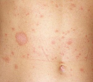 ¿Qué causan las manchas circulares en la piel?
