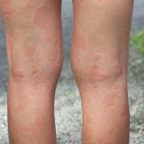 ¿La reacción alérgica en la piel: cómo reconocerla y tratarla?