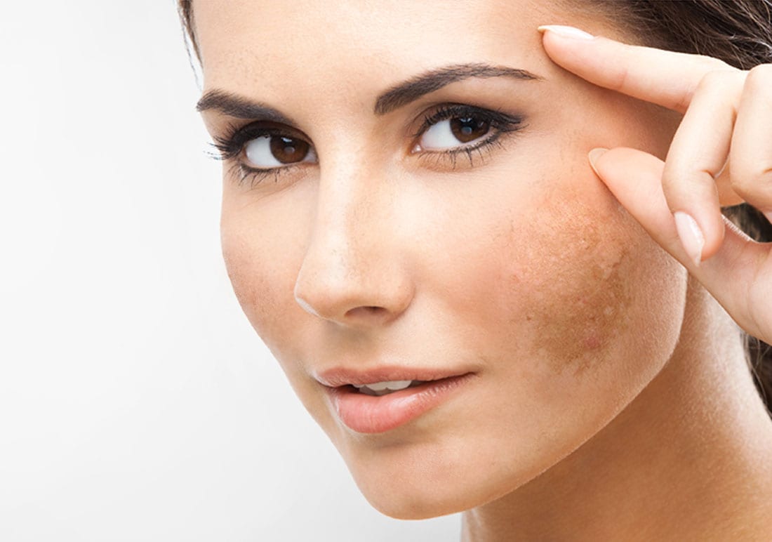 ¿Qué causan las manchas marrones en la piel?