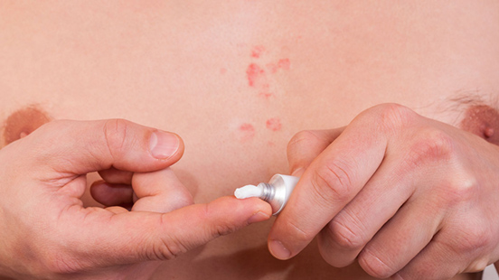 ¿Cómo prevenir y tratar el herpes en la piel?
