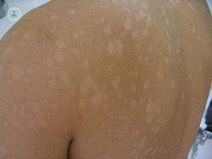 ¿Cómo tratar las manchas en la piel causadas por hongos.?