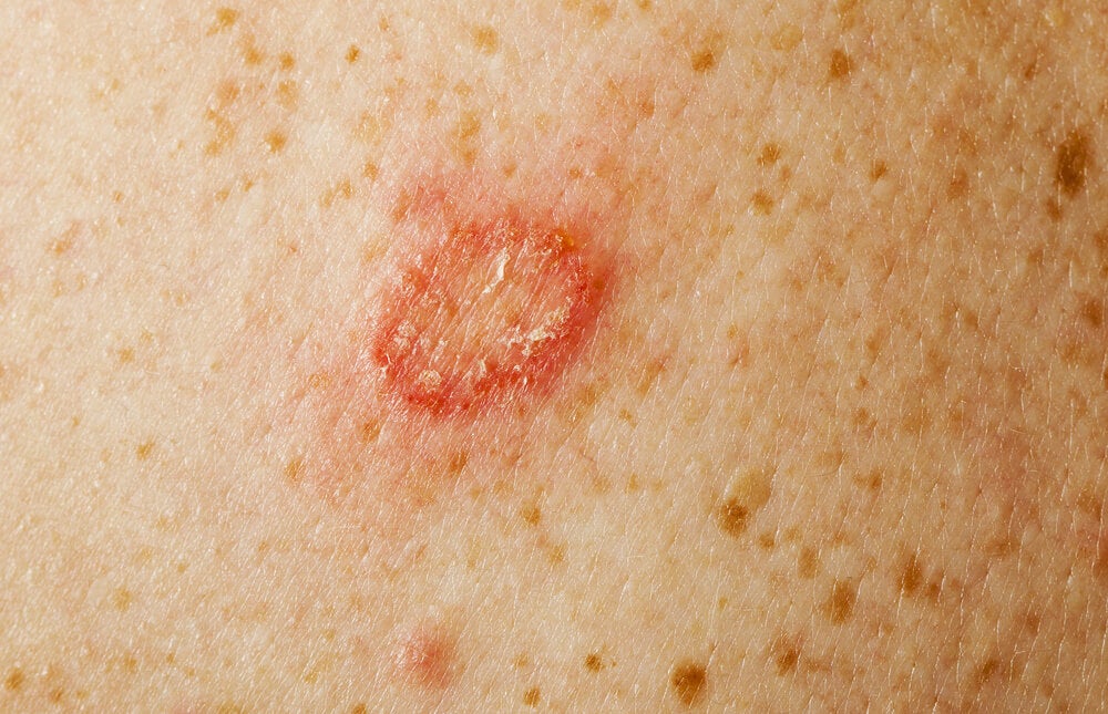 ¿Cómo tratar un hongo en la piel: consejos para una piel sana?