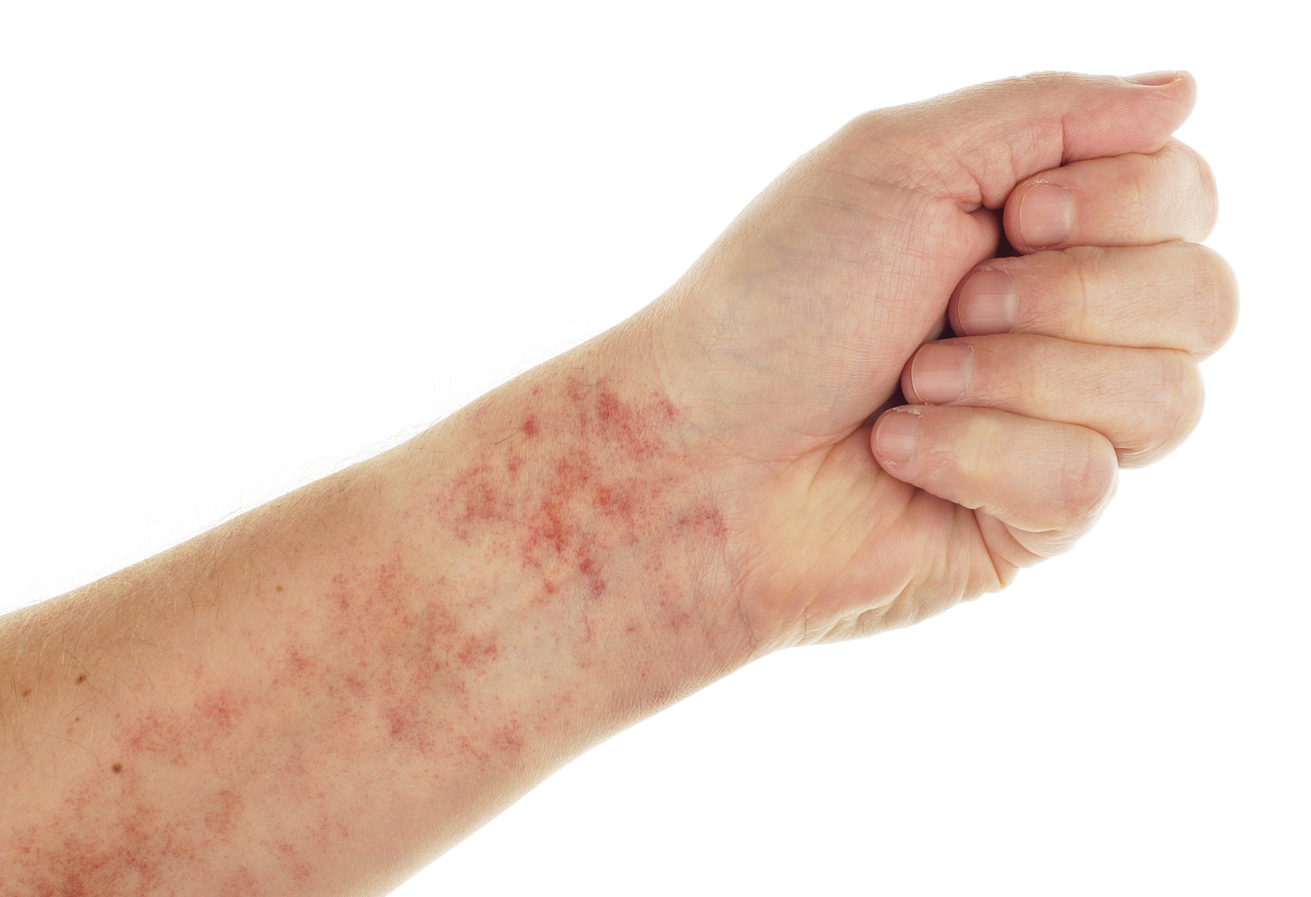 ¿Alerta: ¿podrían las manchas rojas en la piel ser un síntoma de leucemia?