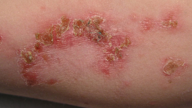 ¿Cómo tratar la infección por hongos en la piel?