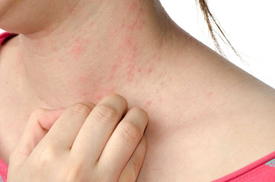 ¿Alerta: ¿puntitos rojos en la piel pueden ser síntomas de leucemia?