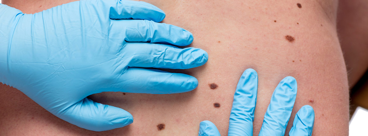¿Cómo identificar y tratar las manchas en la piel benignas?