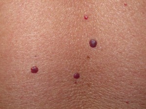 ¿Qué son los granitos rojos en la piel y cómo tratarlos?