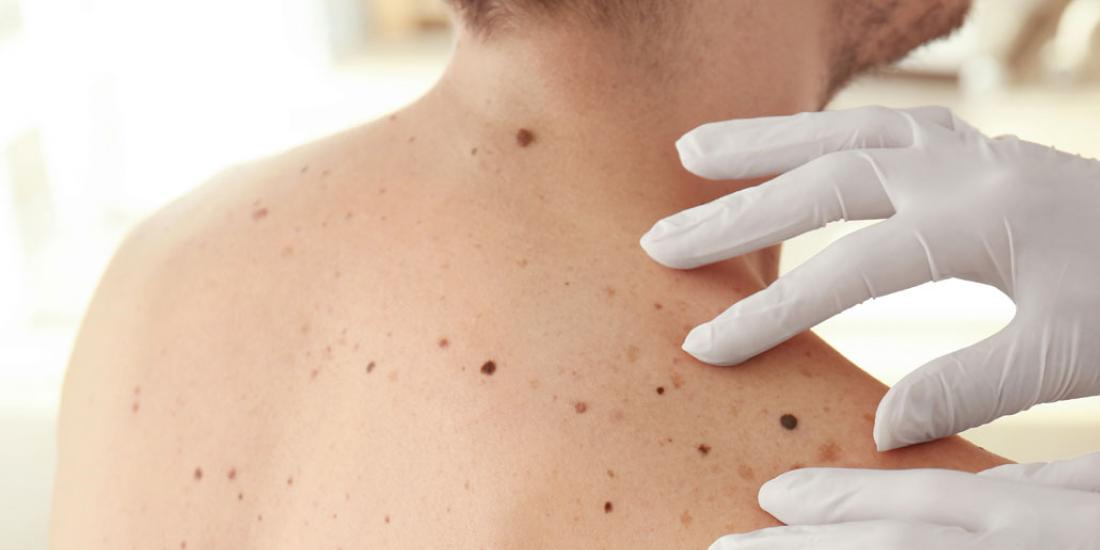 ¿Cómo reconocer y prevenir el cáncer de piel a través de manchas blancas?