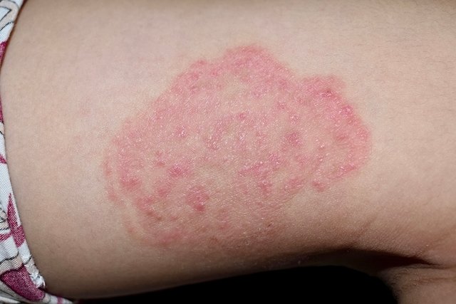 ¿Cómo tratar las manchas rojas en la piel causadas por los nervios?