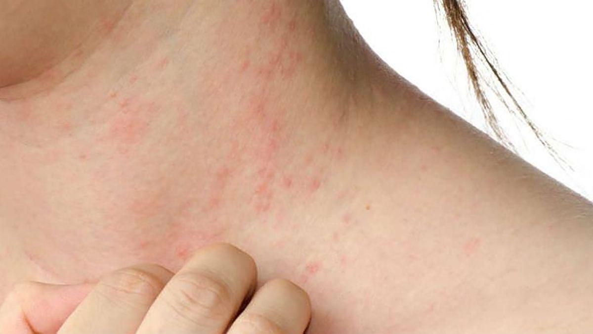 ¿Los síntomas de la piel atópica: ¿Cómo identificarlos?
