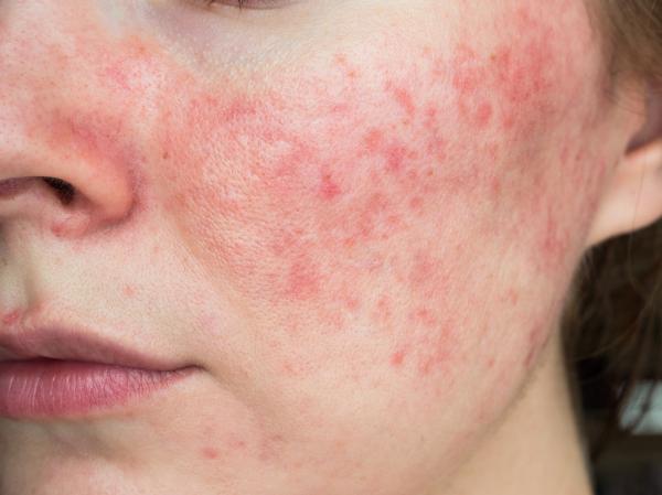 ¿Cómo tratar la piel con granos rojos: consejos para mejorar la apariencia de tu piel.?