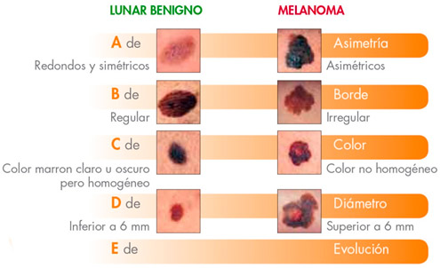 ¿Cómo reconocer los primeros síntomas del cáncer de piel?