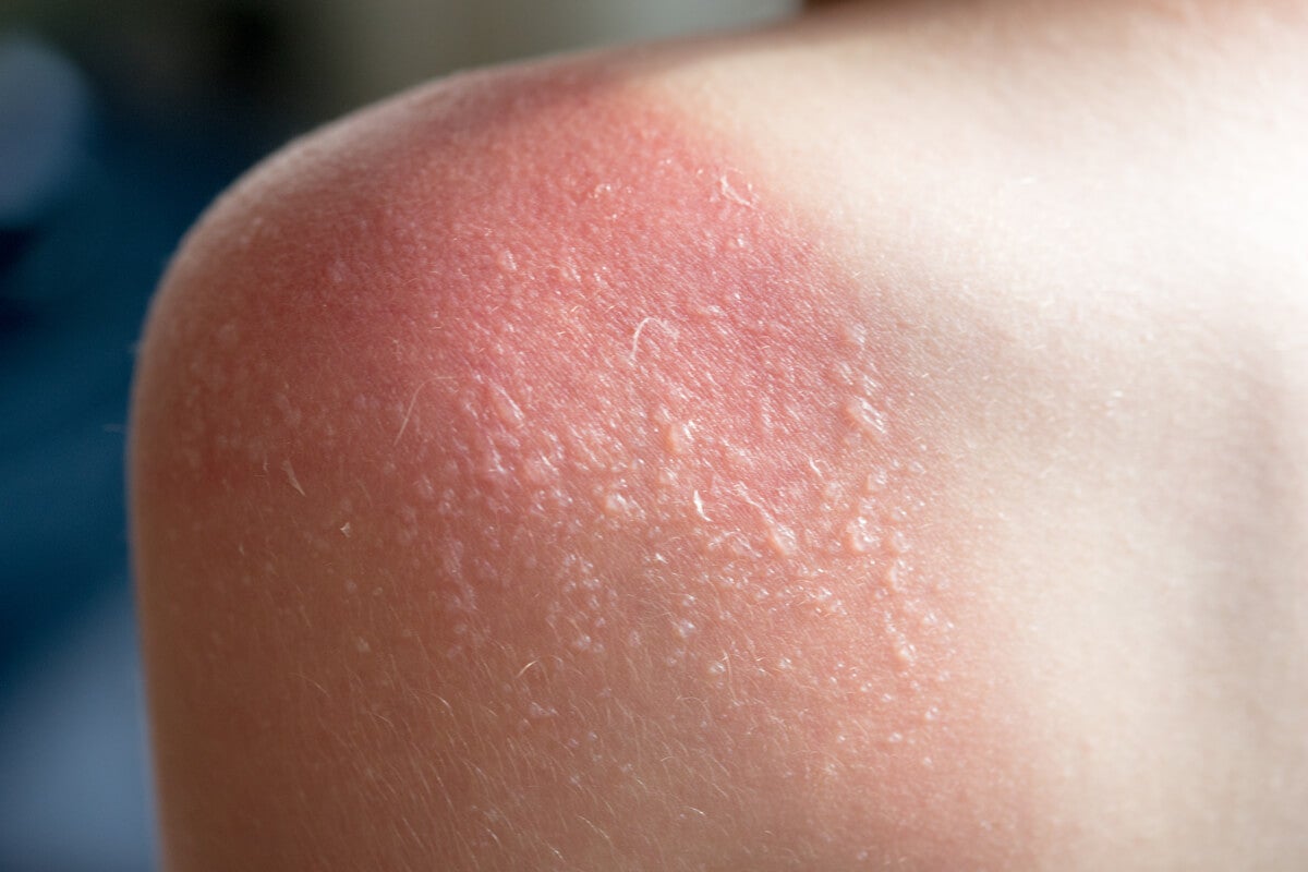 ¿Qué son las vesículas en la piel y cómo tratarlas?