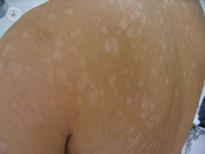 ¿Cómo tratar las manchas blancas en la piel causadas por hongos?