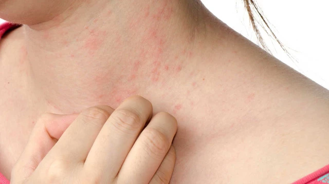 ¿Qué son las manchas rojas en la piel y cómo tratarlas?