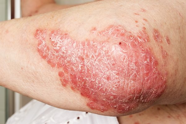 ¿Los peligros de las manchas de hongos en la piel?