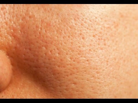 ¿Cómo tratar los agujeros en la piel?