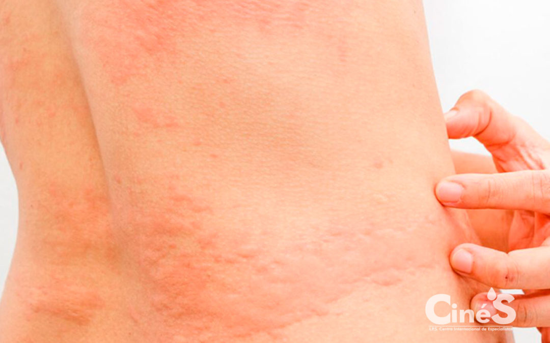 Cómo prevenir y tratar la alergia a los ácaros en la piel