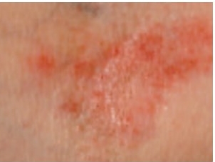 Cómo controlar los síntomas de la alergia en la piel