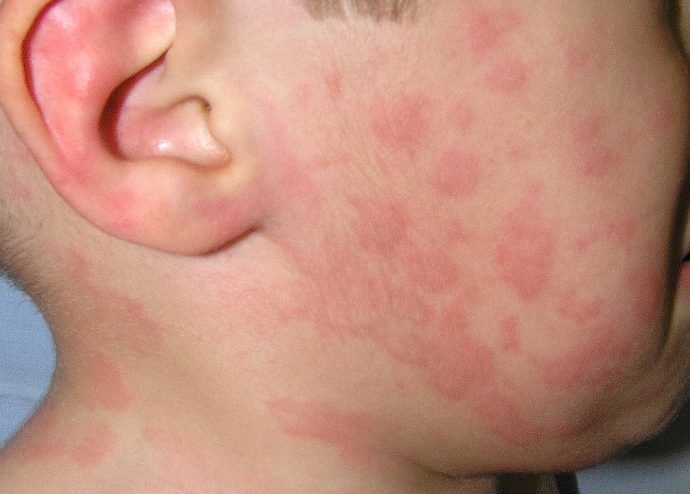 Los peligros de los habones en la piel: ¿cómo prevenir y tratar su aparición?