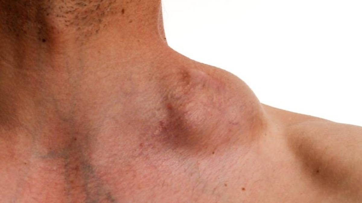 Cómo el linfoma de hodgkin afecta la piel
