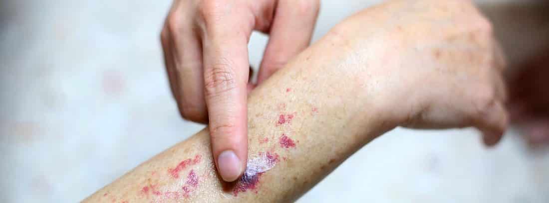 ¿qué son las petequias en la piel? una exploración de los signos y síntomas