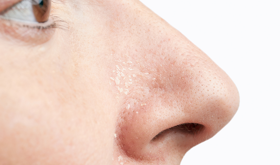 Cuidado de la piel atópica en adultos: consejos y tratamientos para aliviar síntomas