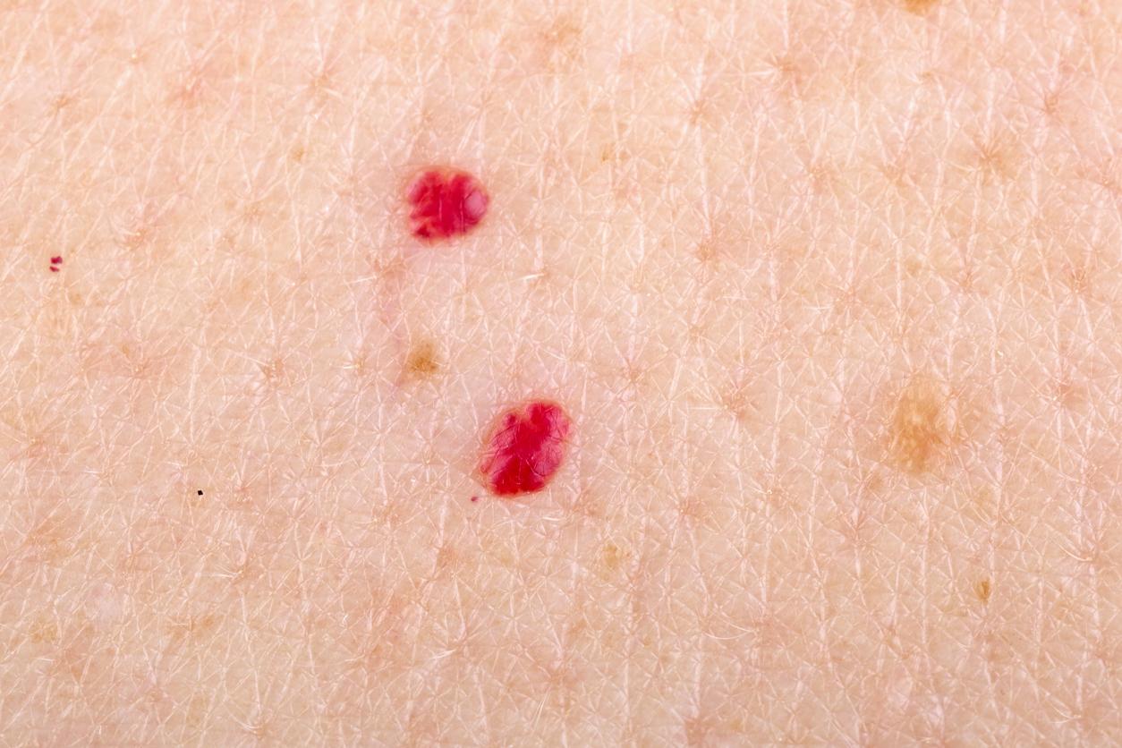 ¿qué significa un punto rojo en la piel?