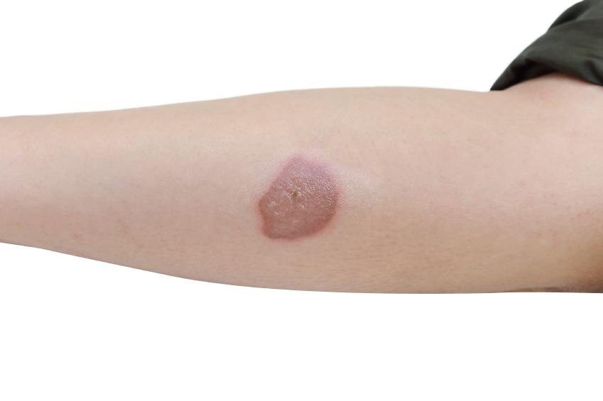 Cómo tratar las úlceras en la piel: consejos para una recuperación rápida